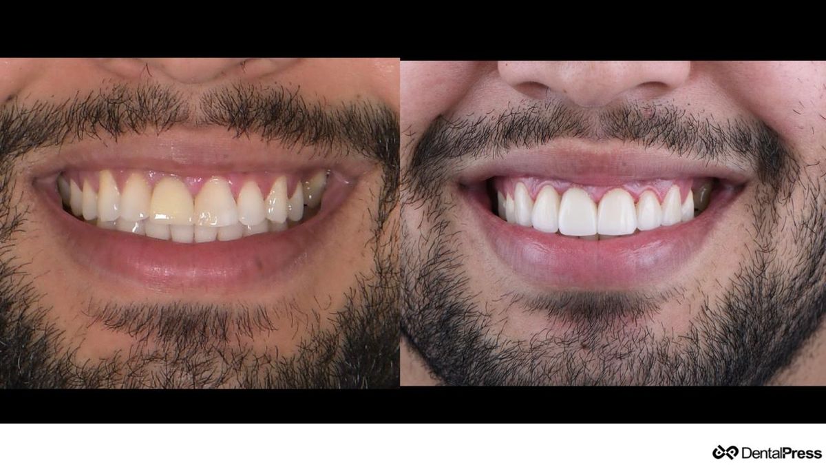 Before and after an aesthetic dental procedure