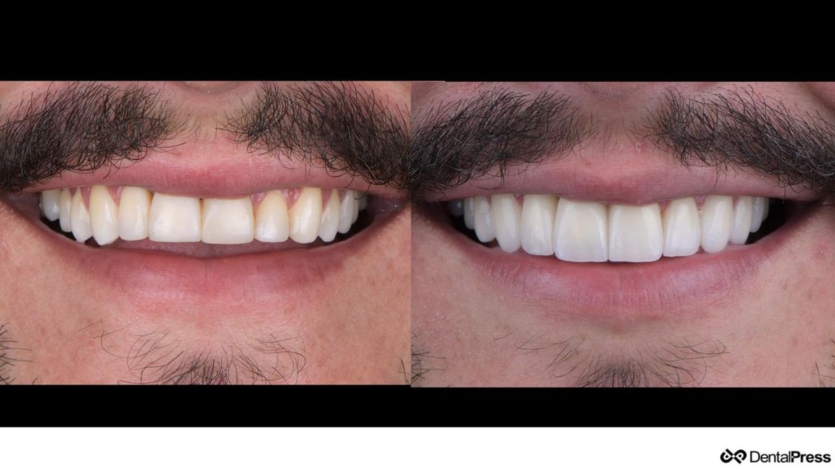 Before and after dental aesthetic transformation